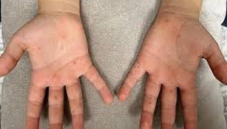 Çocuk Hastalığı Sanılıyor, Ancak Yetişkinlerde de Görülüyor: El, Ayak, Ağız Hastalığına Karşı Önlemler