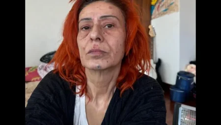 Yıldız Tilbe saç boyası nedeniyle kimyasal yanık oldu! Son halini paylaştı