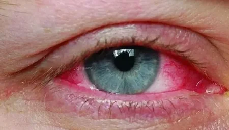 Kırmızı Göz Belirtisini Hafife Almayın! Görme Kaybına Yol Açabilir