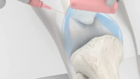 Hidrojel Enjeksiyonu Osteoporoz Tedavisinde Yeni Bir Dönem Başlatabilir