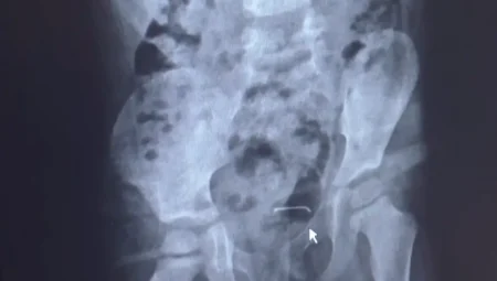 Bitlis’te 5 Yaşındaki Çocuğun Mesanesinden Çıkan Cisim Şaşkına Çevirdi