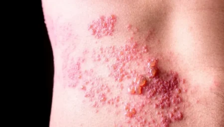 Uzman Uyarısı: Zona Hastalığı Görme Kaybına Neden Olabilir