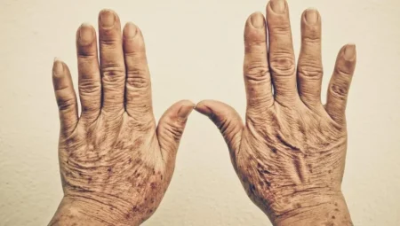 Ellerde Beliren Mavi Damarlar Ne Zaman Ciddi Bir Sağlık Sorununa İşaret Eder?