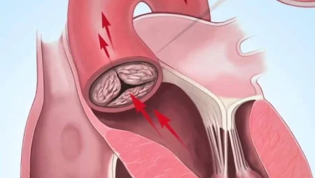 Aort diseksiyonu ölümlerin %40’ına neden oluyor: Belirtiler ve tedavi yöntemleri neler?